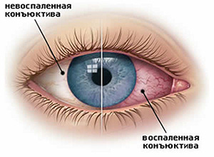 Воспаление слизистой оболочки глаза